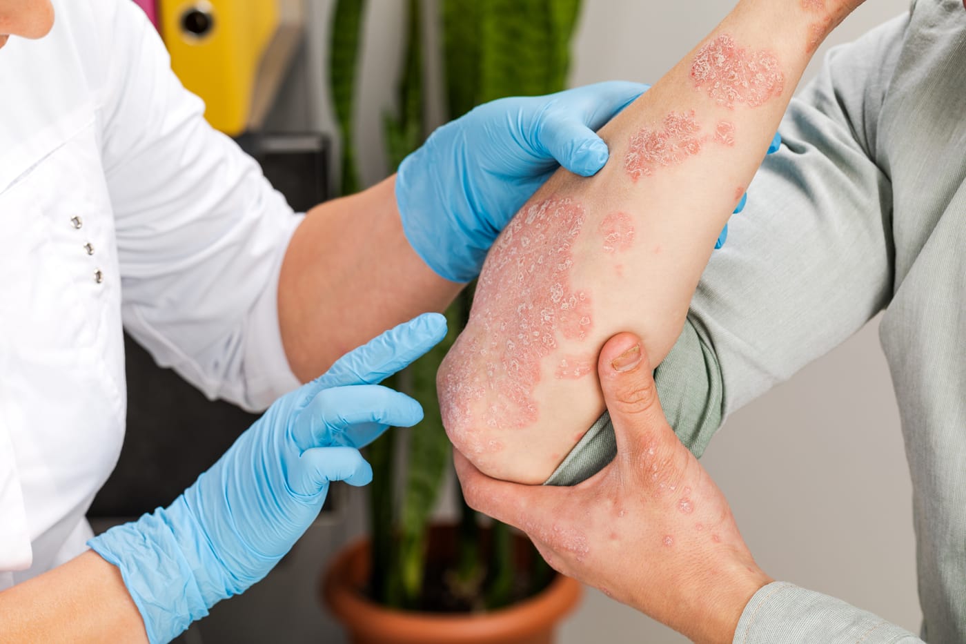 Examen dermatológico, con guantes, de placas de psoriasis elevadas y escamosas en el codo y el antebrazo
