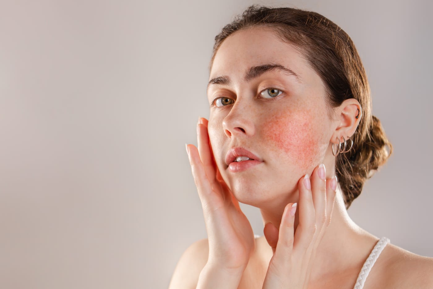 A young woman touches her face, her cheeks flushed with the redness of rosacea
