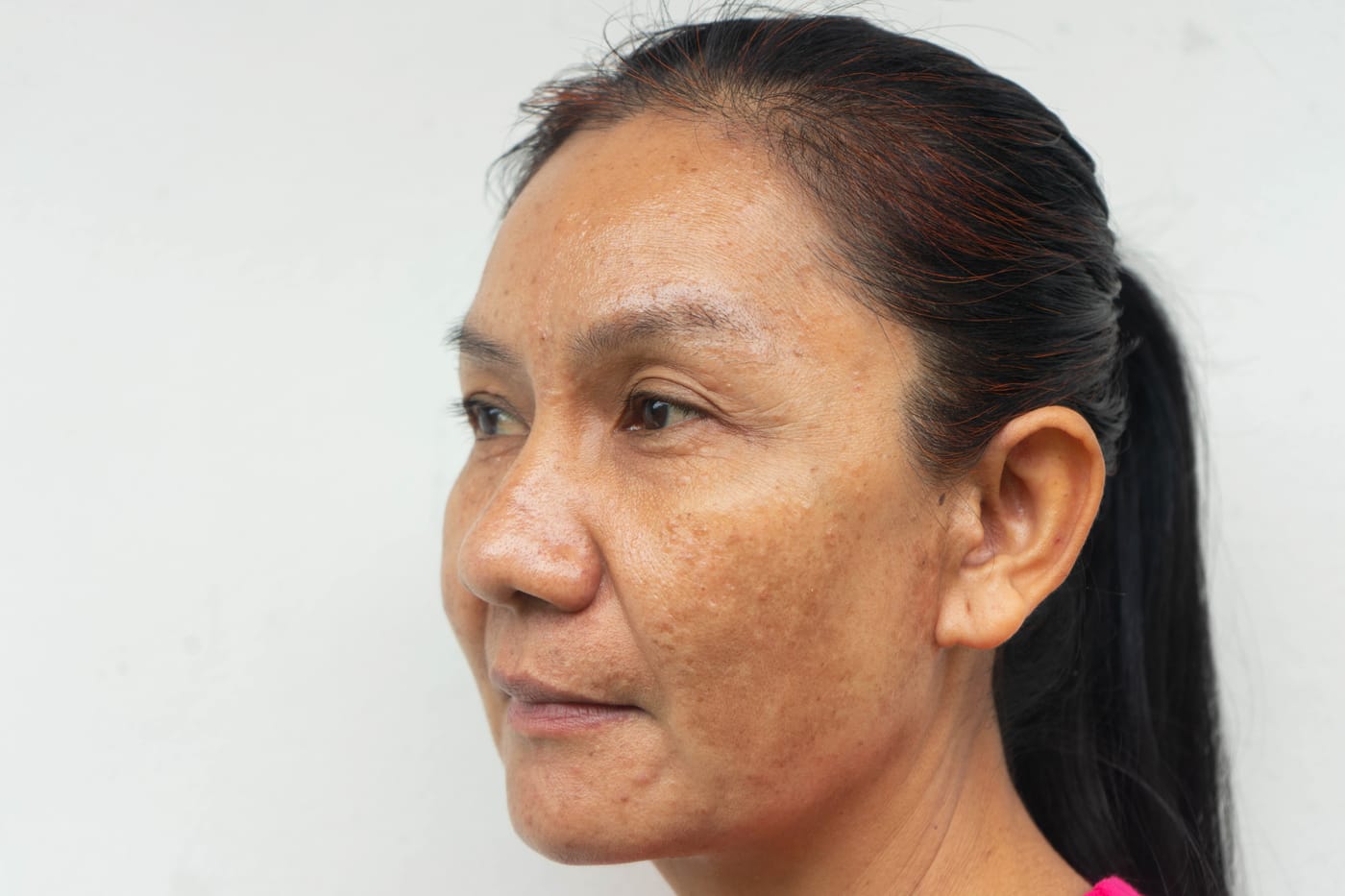 A woman in profile, the skin of her cheek marked with sun spots and uneven pigmentation