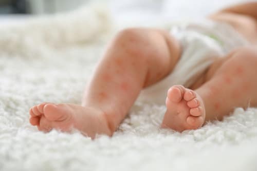 A baby's legs with patches of red, irritated eczema