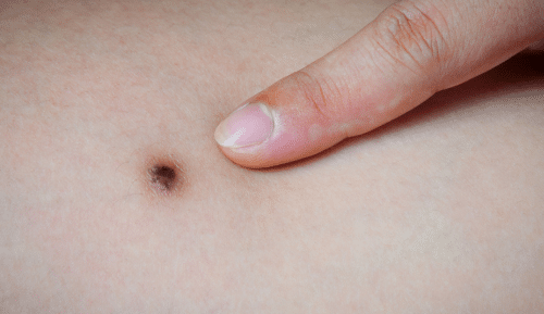 Melanoma 101