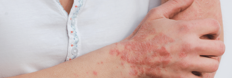Seasonal Changes and Psoriasis Managing Your Symptoms