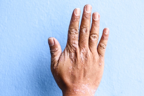 Hand afflicted by psoriasis in front of light blue background