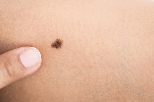 melanoma