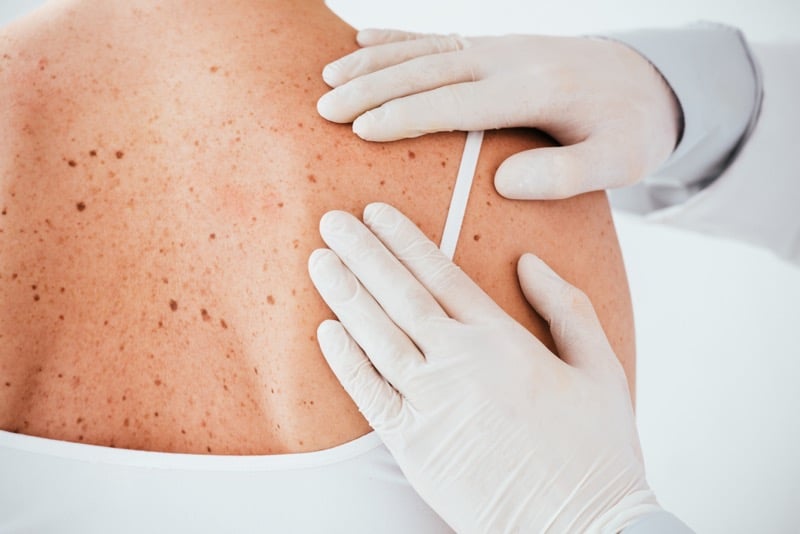 cropped view of dermatologist in latex gloves examining woman with skin disease isolated on white